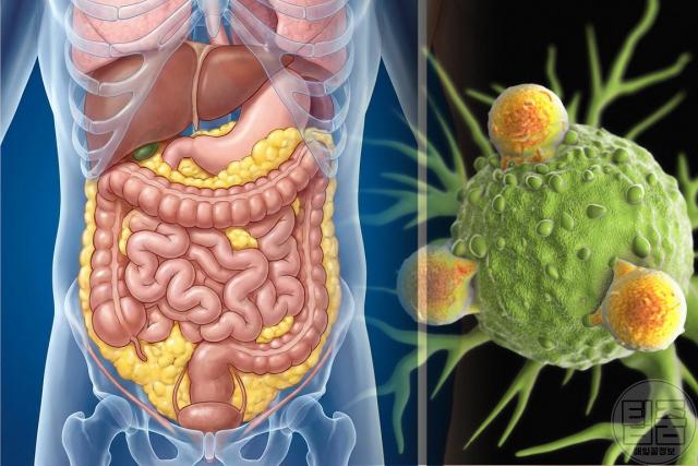 내장지방 대장암