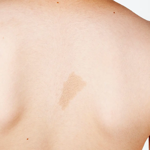 신경섬유종 초기 증상, 혹시 나도? 놓치면 안 되는 신호