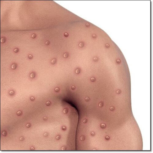 엠폭스 증상 및 발진