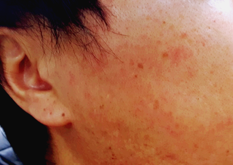 점이많은-얼굴-옆모습