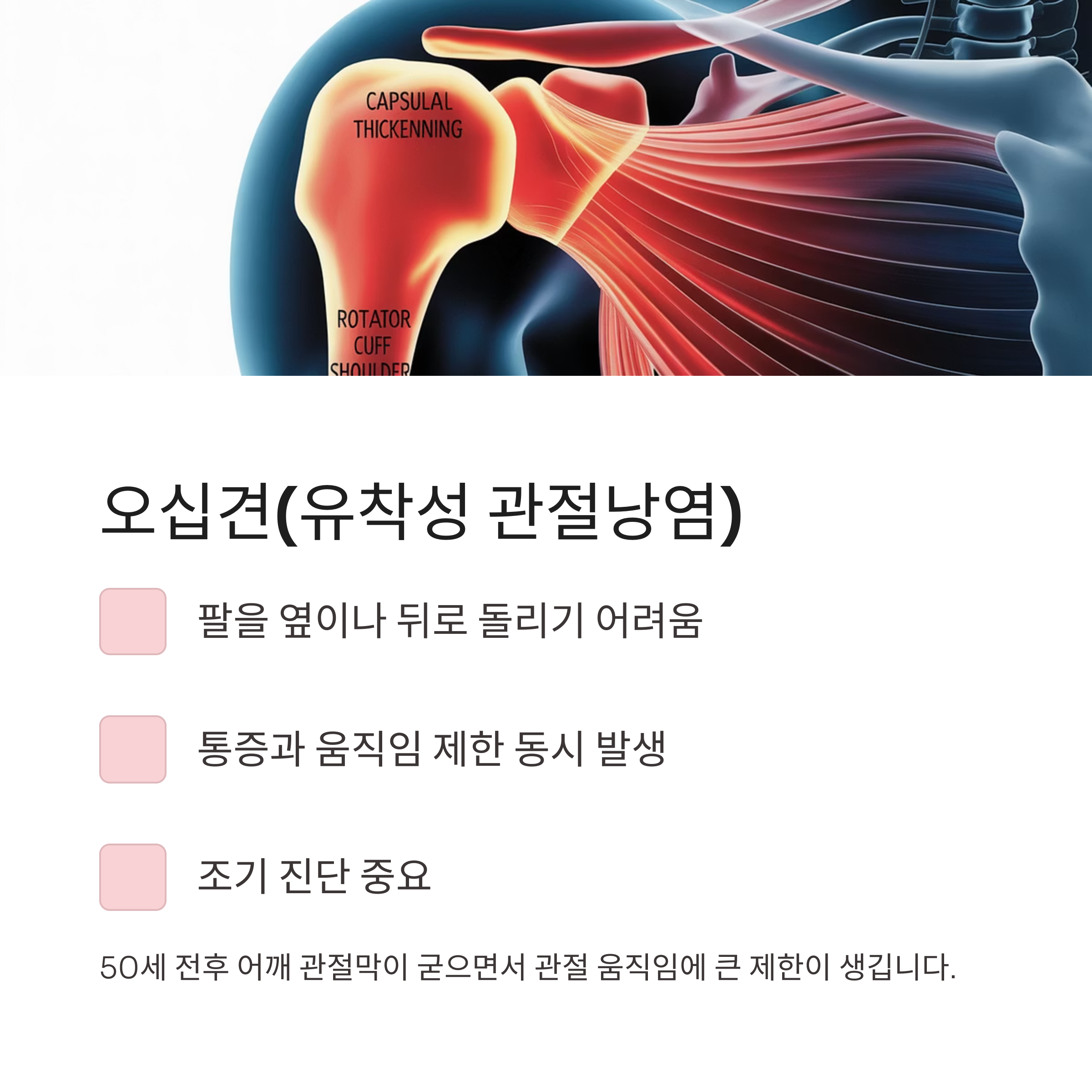 오십견(유착성 관절낭염)의 특징과 증상을 설명하는 어깨 관절 구조 이미지