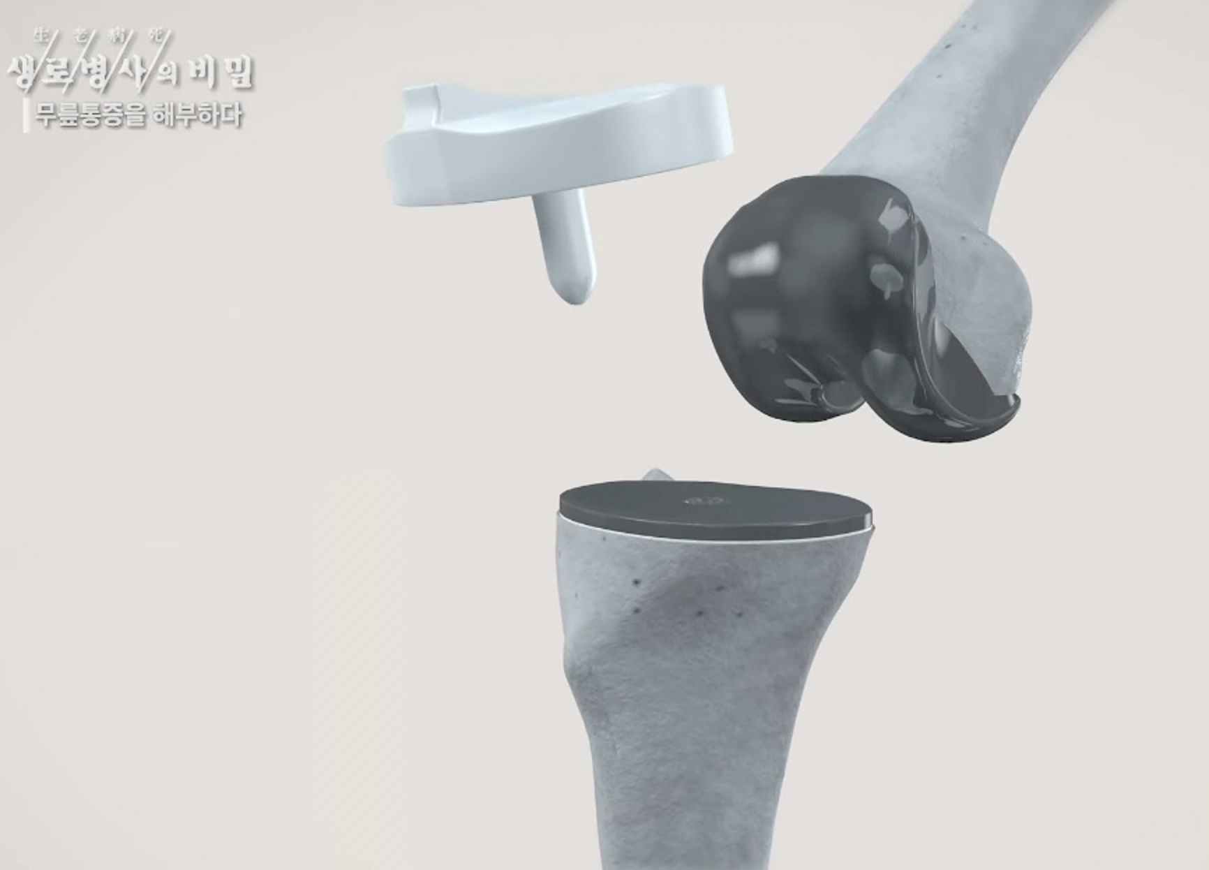 EBS-명의-박관규-교수