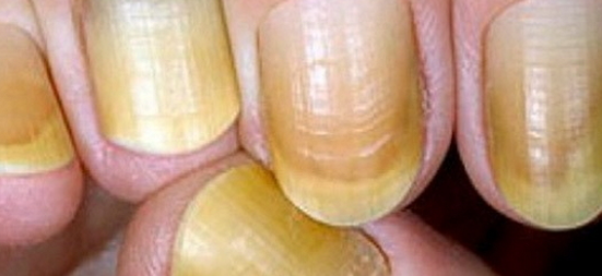 노란손톱
