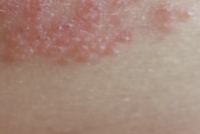 대상포진 치료방법 섬네일