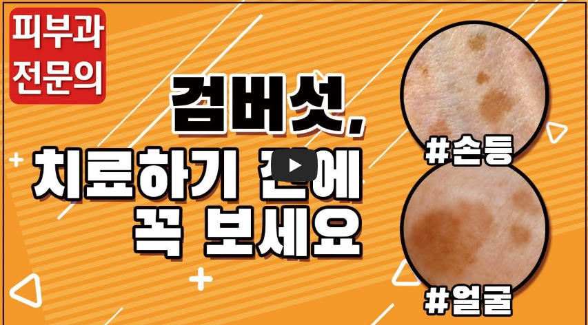 검버섯 없애는 방법과 꿀팁 총정리