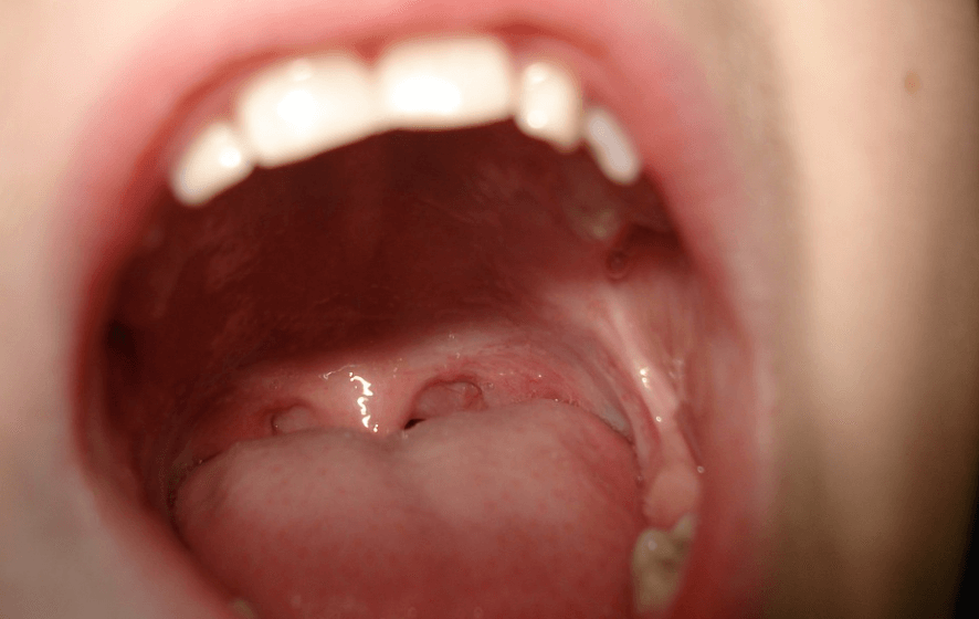 백태 없애는 방법으로 입안을 보여 주고 있다