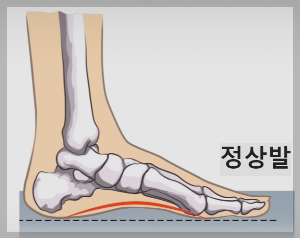 족저근막염발바닥 통증