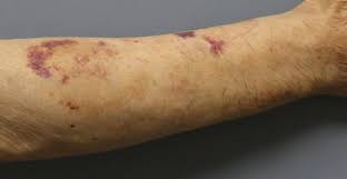 멍이 잘 드는 이유와 예방 방법