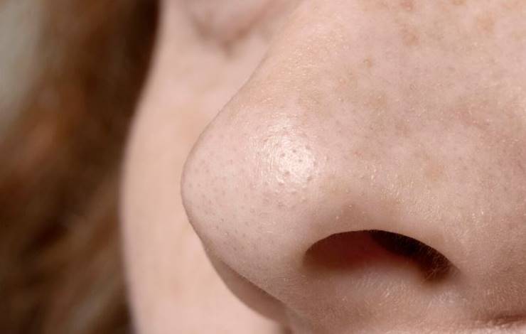 얼굴피지 제거방법