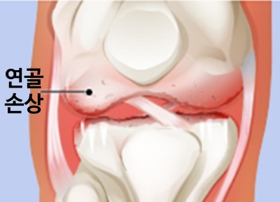 무릎관절염-3기