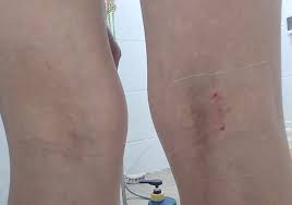 오금이 아픈 이유