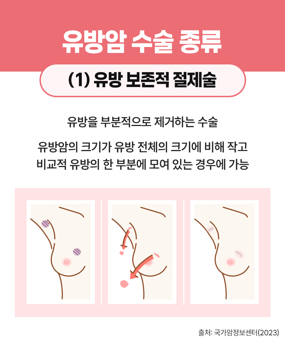 #유방암 수술 종류 유방 보존적 절제술