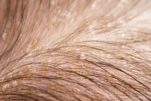 두피 지루성 피부염 치료 9가지