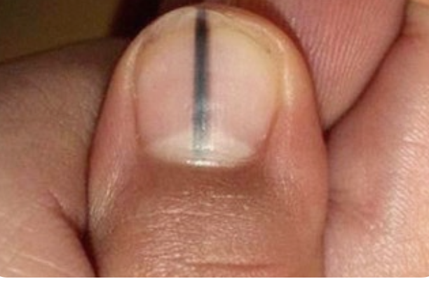 손톱 세로줄 관련된 사진2