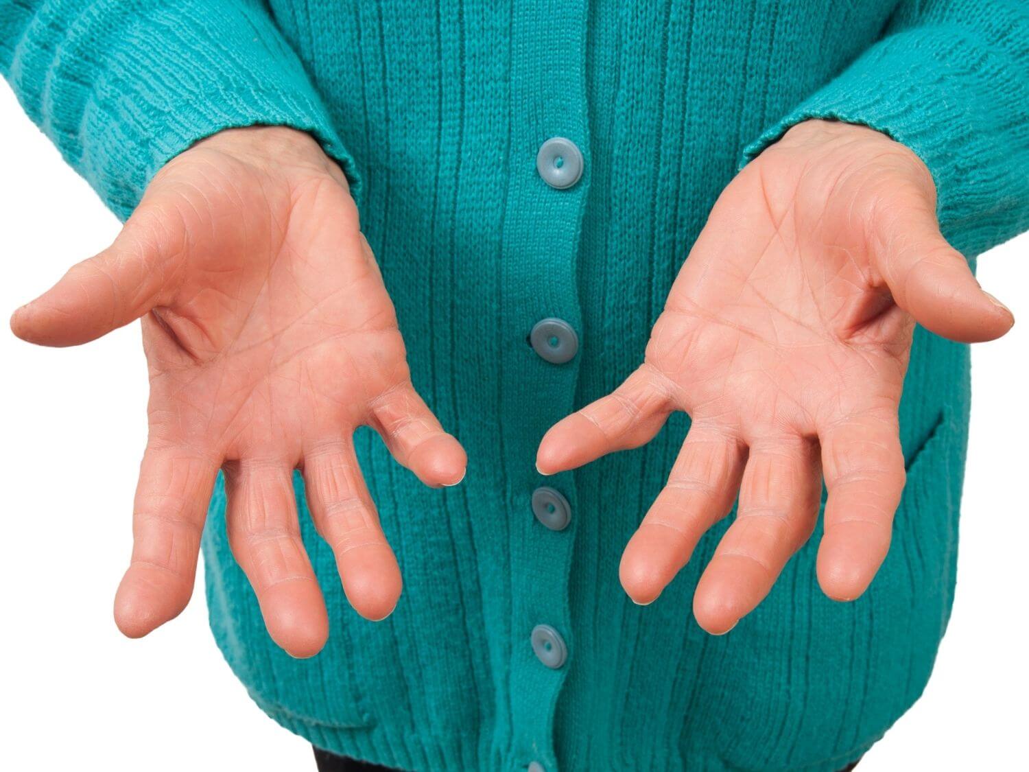 손가락 관절염 증상