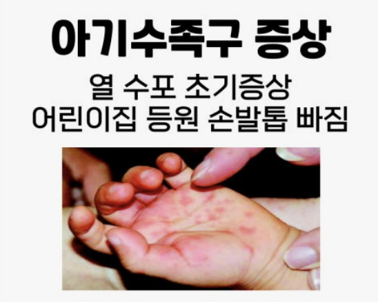 수족구 증상 - 아이 키우며 겪은 진짜 이야기