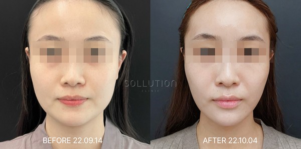 피부과 울쎄라 전후 사진