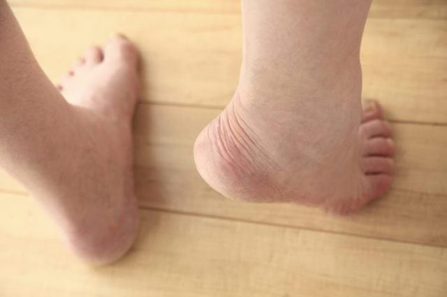 허리디스크 추간판탈출증 전조증상 한쪽다리 저림
