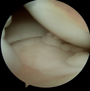 연소기 특발성 관절염(Juvenile Idiopathic Arthritis, JIA): 원인, 증상, 진단 및 치료