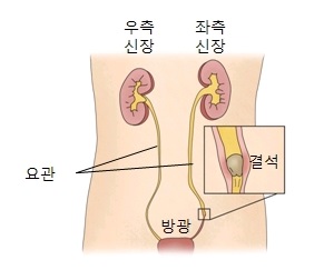 요로결석 (신장결석)