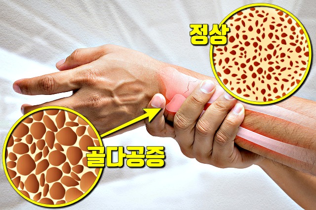 뼈 잘붙는 음식,뼈에 좋은 음식,골다공증에 좋은음식