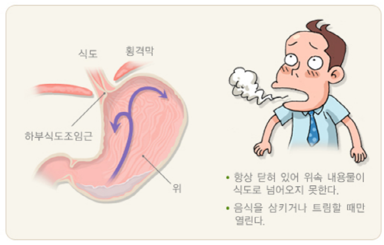 역류성식도염 증상