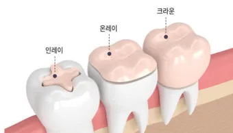 인레이 온레이의 차이와 치료 방법_5