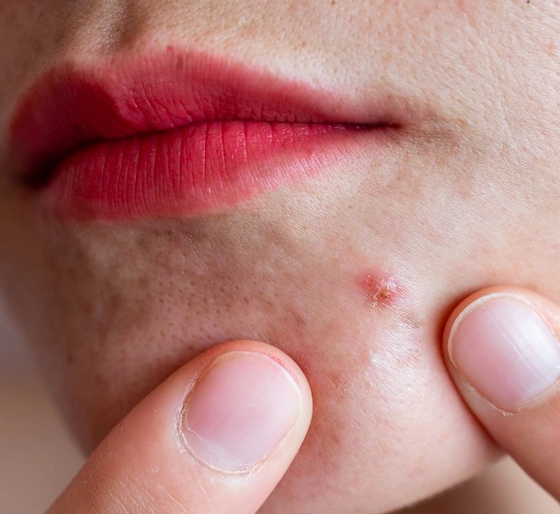 화농성 여드름 관리법 총정리