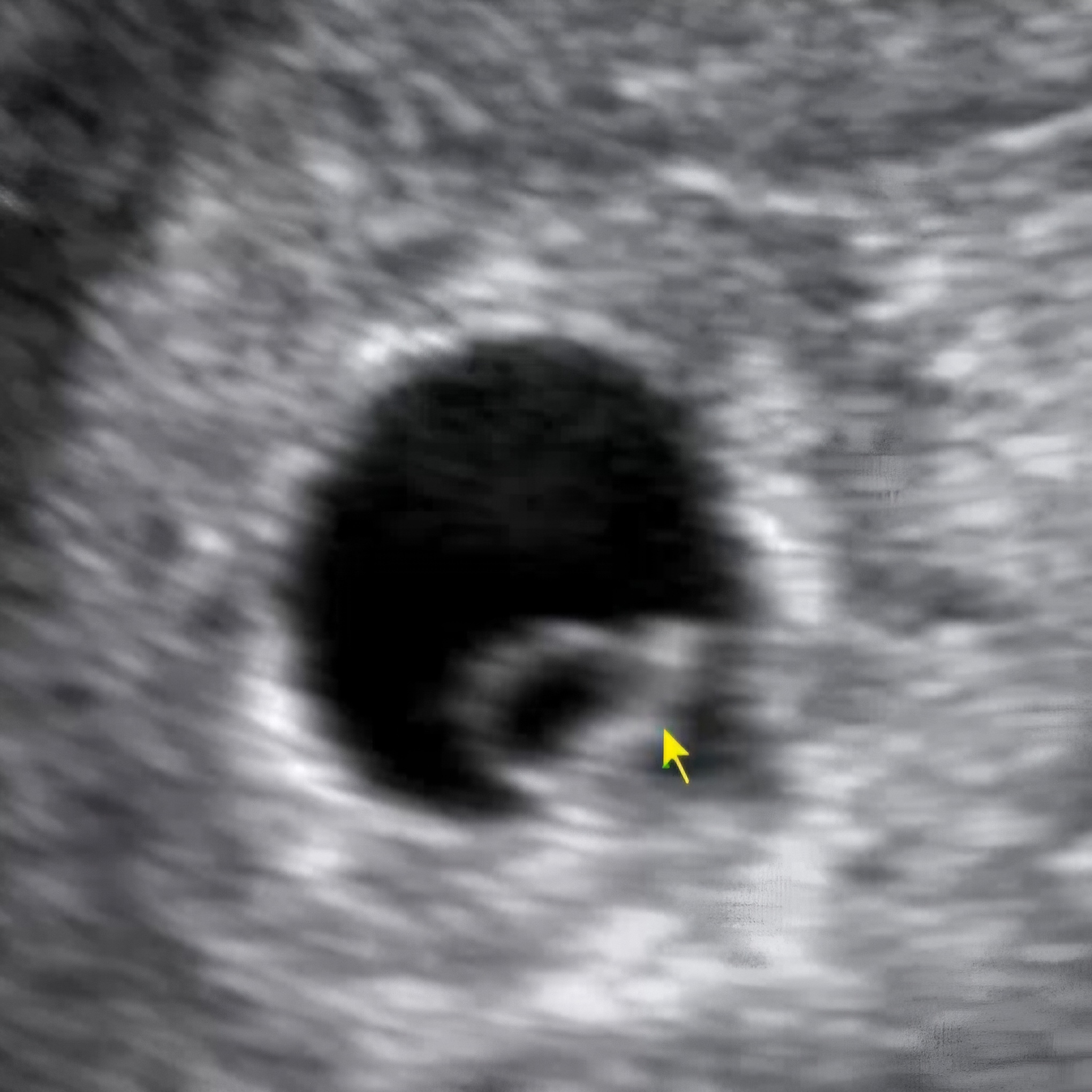 난항의 위치로보는 태아 성별확인