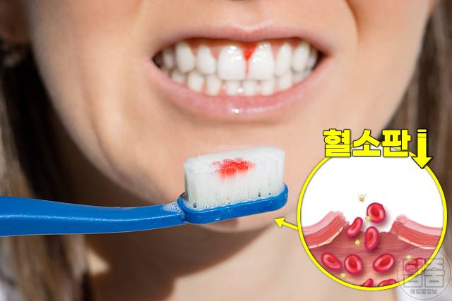 소변거품 어느정도 요독증 증상 잇몸 피