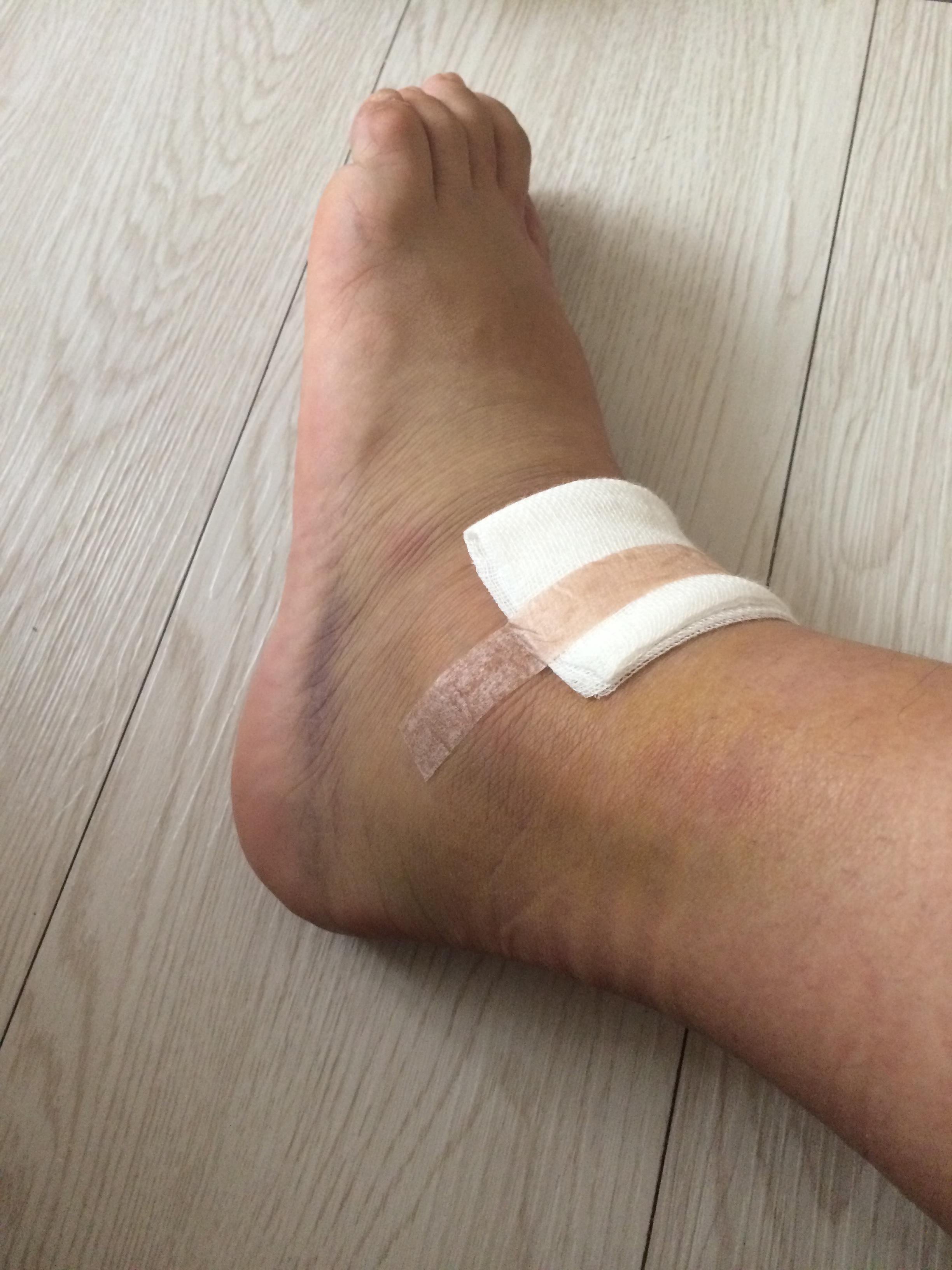 수술 후 발목사진