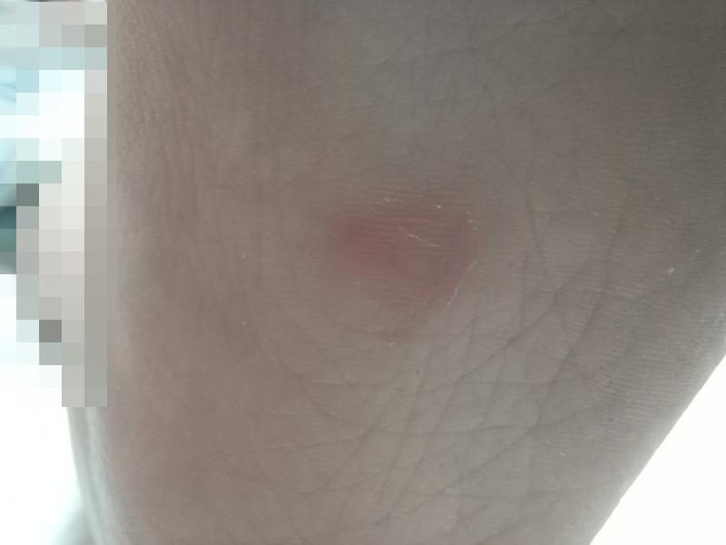 굳은살 냉동치료 완치