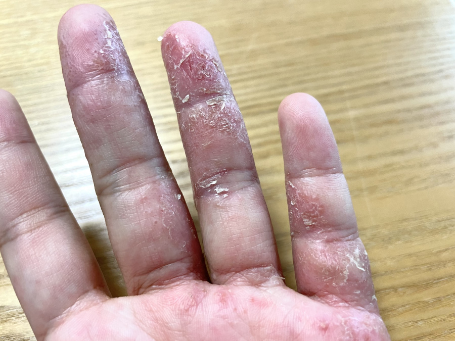 손가락의 피부가 붉게 변하고 수포가 생기고 피부가 벗겨지고 간지러운 증상인 주부습진 가지고 있는 사람의 손을 확대를 하여 찍은 사진