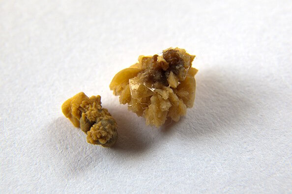 몸에서 만들어진 결석들