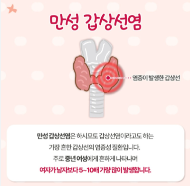 만성 갑상선염 증상