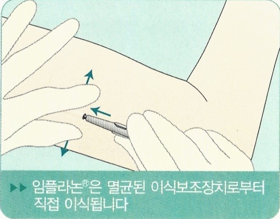 임플라논