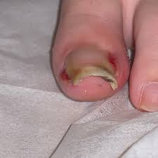 내성발톱 자가치료