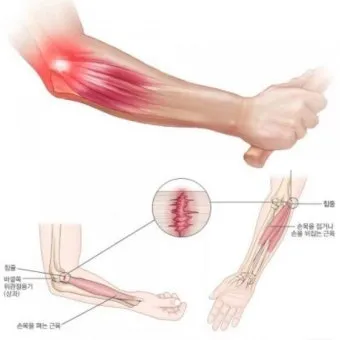 팔꿈치 통증 원인 6가지증상운동법예방법치료법까지_18
