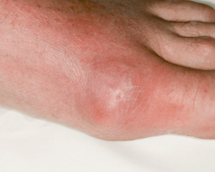 통풍 관리와 치료는 어떻게?