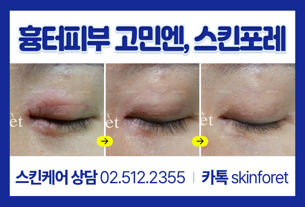 앞트임세로주름, 소세지눈, 몽고주름이 함께 나타난 복합 사례
