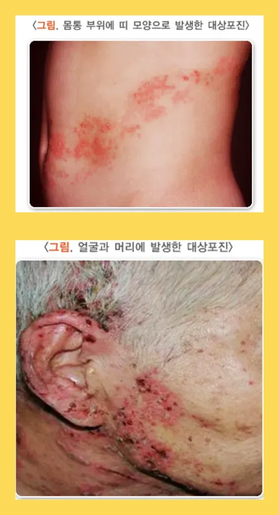 대상포진이란?_출처:질병관리청