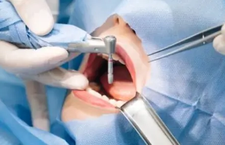 사랑니 발치 후 식사