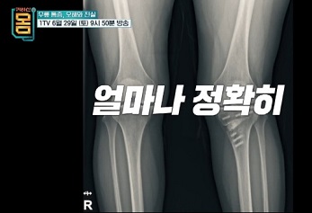 퇴행성관절염