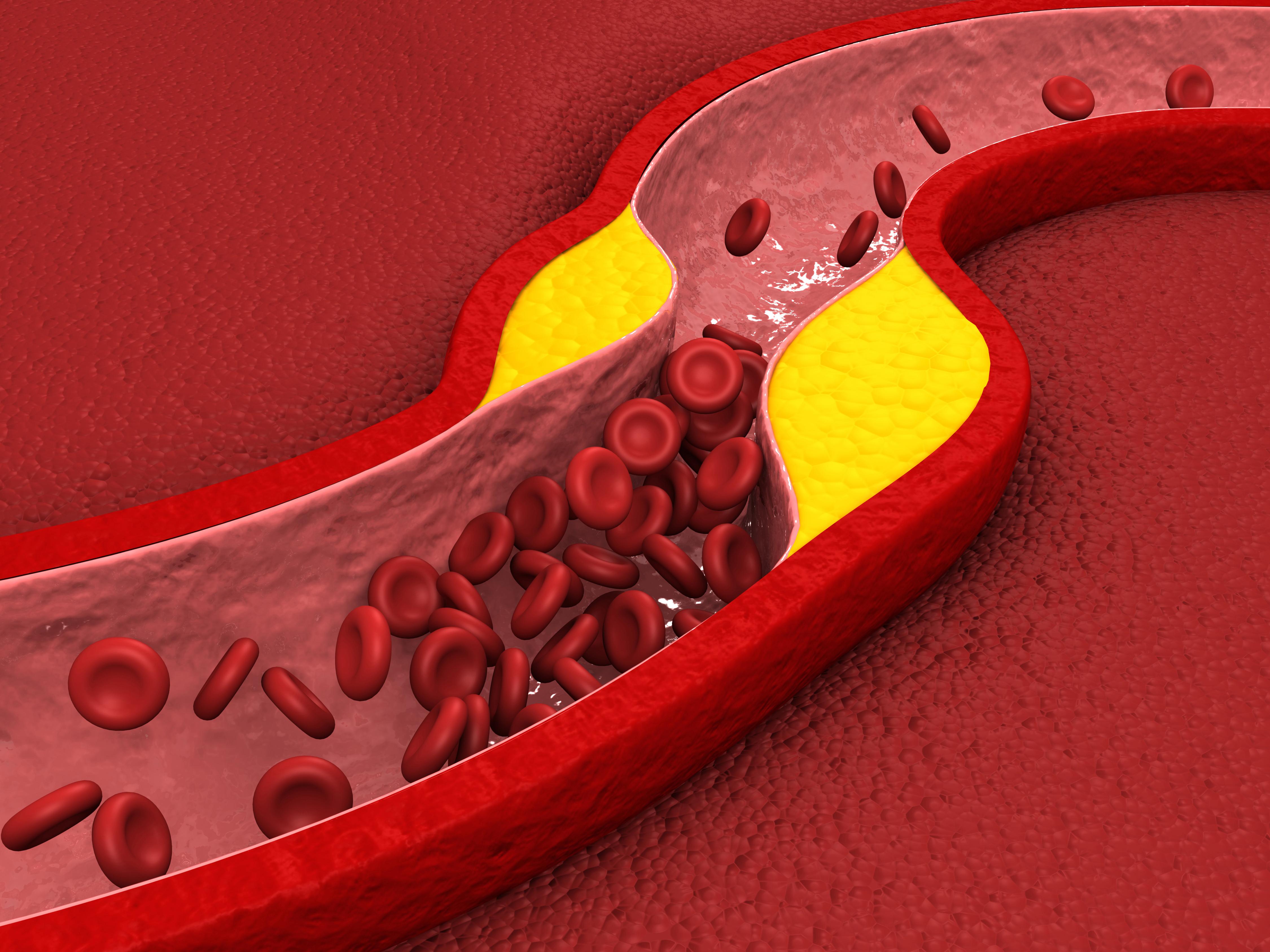 콜레스테롤 증가