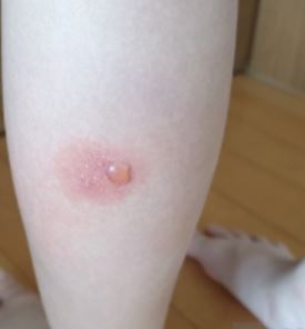 모기 물림 스키터 증후군