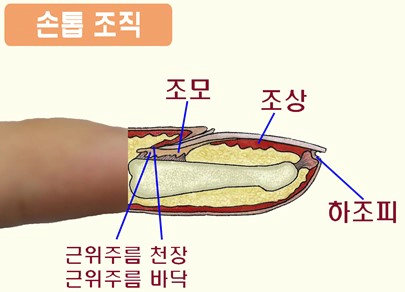 손톱 검은세로줄 원인 5가지 및 흑색종 검사 및 치료방법