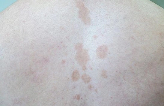 어루러기 증상 3가지 및 어루러기 원인과 치료 총정리 (자주묻는질문)