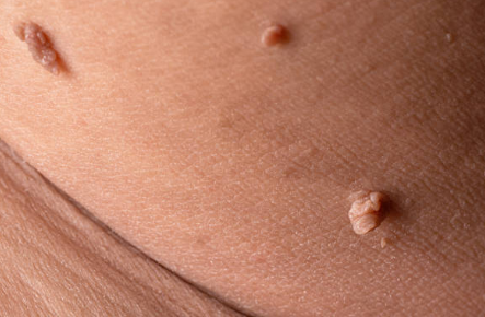 쥐젖 제거방법, 쥐젖이 생기는 이유, 제거 연고 총정리 (2024ver)