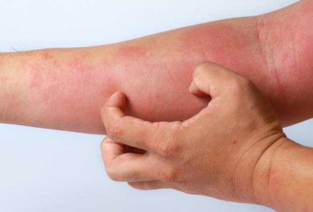 콜린성 두드러기의 원인