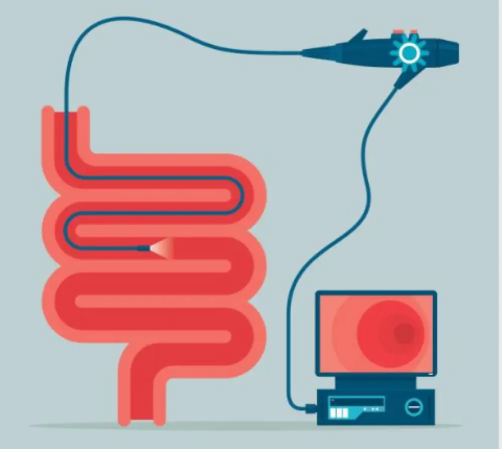 위내시경 이미지